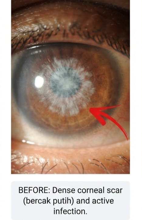Before eye