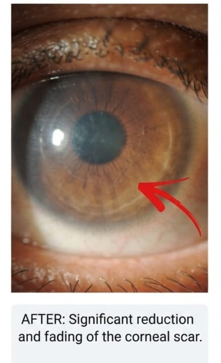After eye